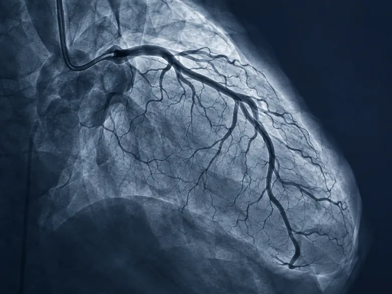 Illustration representing CCTA