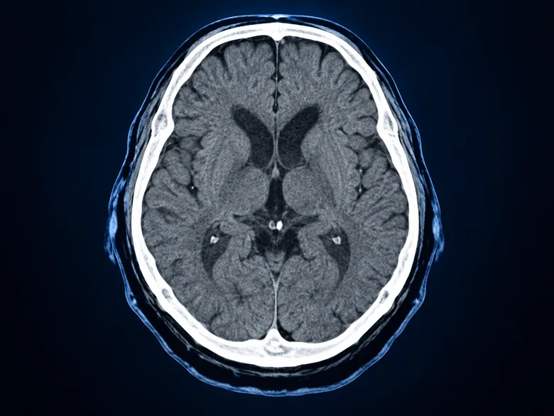 Illustration representing CT Brain
