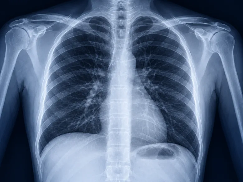 Illustration representing Chest X-ray